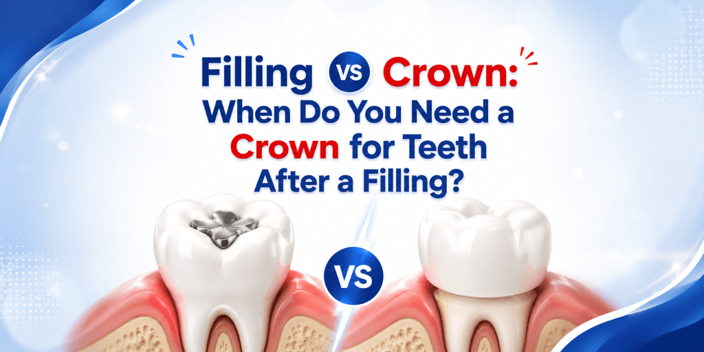 Filling vs Crown