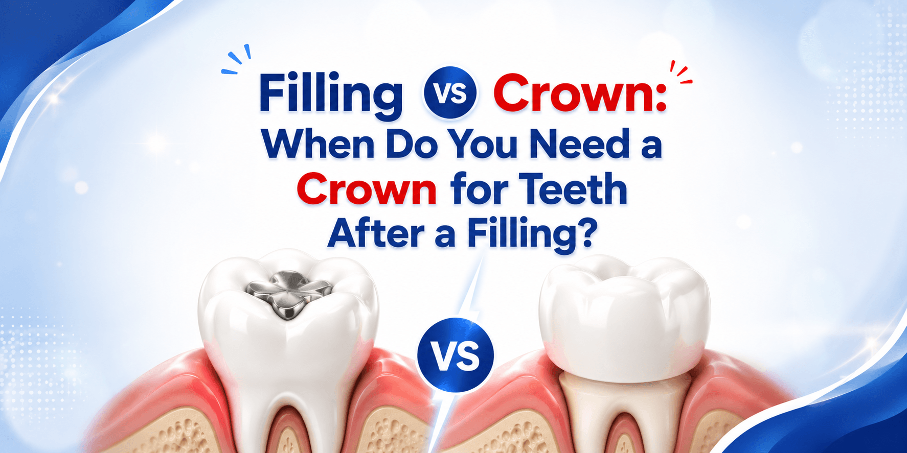 Filling vs Crown